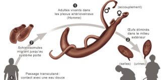 Schistosomiase - Bilharziose
