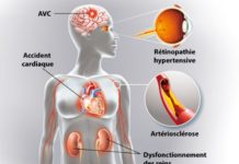 Sémiologie de l'hypertension artérielle (HTA)