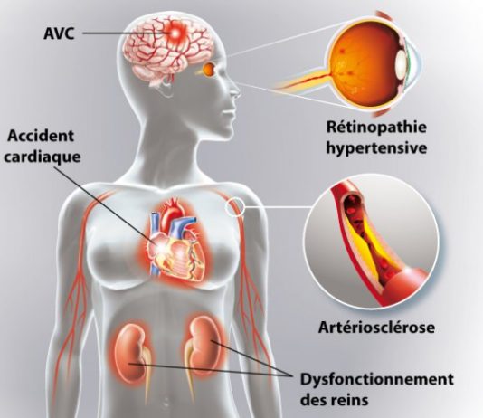 Sémiologie de l'hypertension artérielle (HTA)