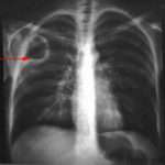 L'abcès du poumon (suppuration parenchymateuse pulmonaire)