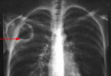 L'abcès du poumon (suppuration parenchymateuse pulmonaire)