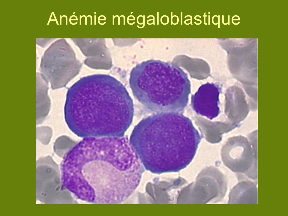 l anemie megaloblastique