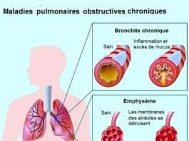 Bronchite aigue