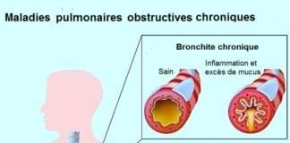 Bronchite aigue