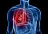 Cancers secondaires du poumon