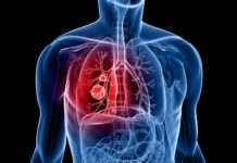 Cancers secondaires du poumon
