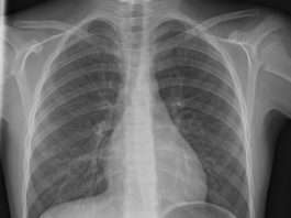 Exploration radiologique du poumon