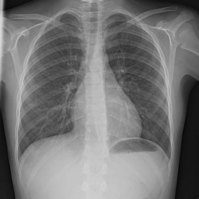 Exploration radiologique du poumon