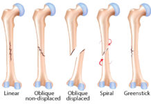 Généralités sur les fractures