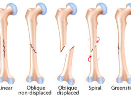 Généralités sur les fractures