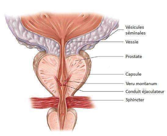 adenom de la prostate