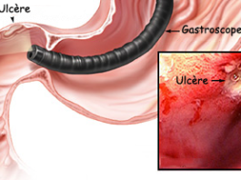 Maladie ulcéreuse gastro-duodénale