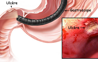 Maladie ulcéreuse gastro-duodénale