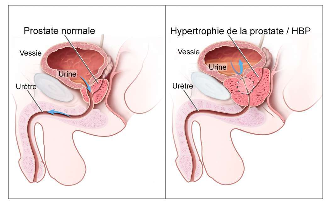 Prostate Hyperplasia 40 élő prosztatitis