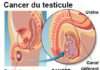 Tumeurs du testicule