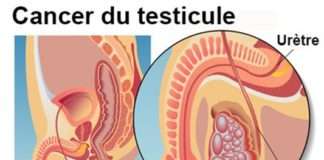 Tumeurs du testicule