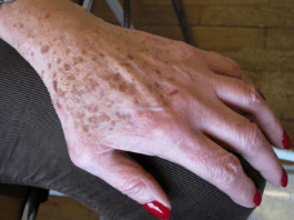 Lentigos séniles sur la face dorsale de la main.