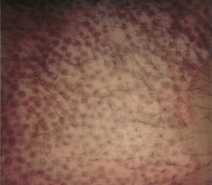 Mácula blanca o acromática con islotes de repigmentación alrededor de los folículos pilosos durante un vitiligo.