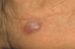 Skin nodule of inflammatory cause (sarcoidosis)