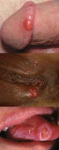 genital ulcers and urethritis 1