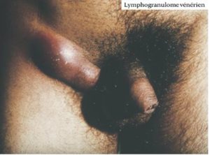 陰部潰瘍や尿道炎 3