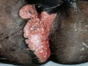 陰部潰瘍や尿道炎 5